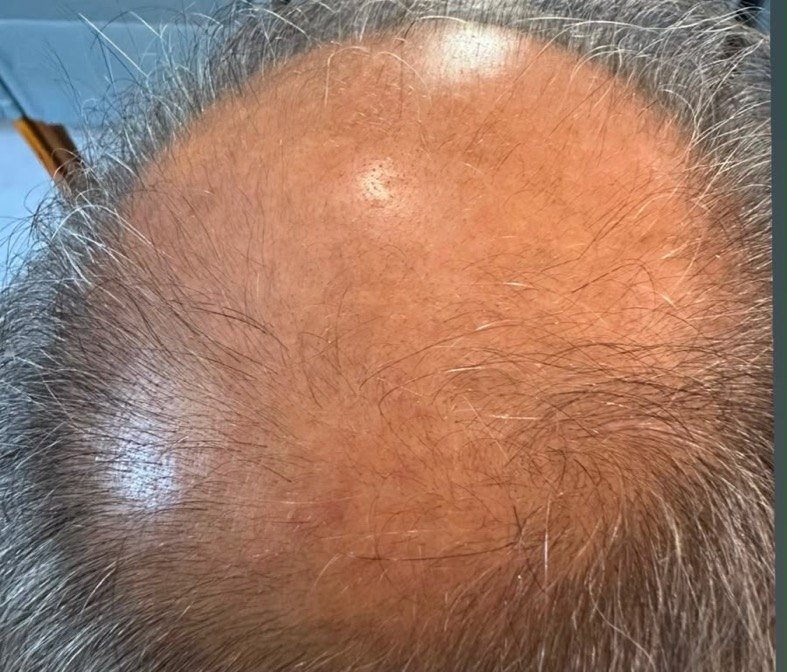 Topo da cabeça do paciente antes do protocolo: couro cabeludo bastante aparente na coroa, com fios ralos